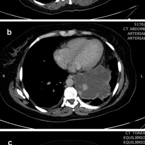 Ct In Axial Plane After Intravenous Contrast Of Abdomen Showing The