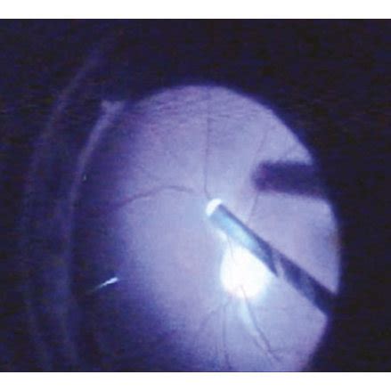 Formation Of Surgical Posterior Vitreous Detachment PVD A The