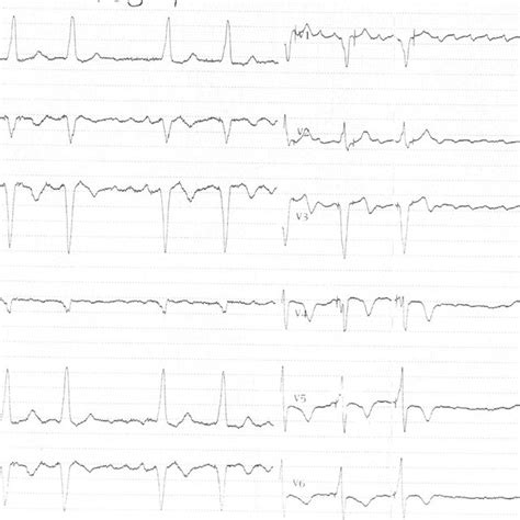 Twelve Lead Electrocardiogram On Admission Download Scientific Diagram