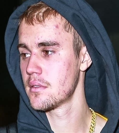 Justin Bieber Diagnosed With Lyme Disease Insists I Am Not On Meth Jim Heath Tv