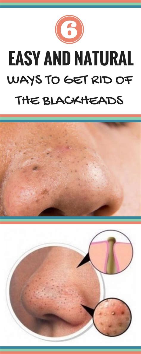 6 Easy And Natural Ways To Get Rid Of The Blackheads Skin Care