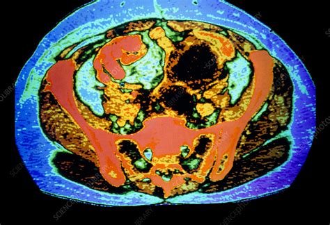 Coloured Ct Scan Showing Cancer Of Uterus And Ovary Stock Image M850