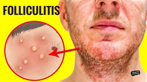 How To Get Rid Of Folliculitis At Home Youtube