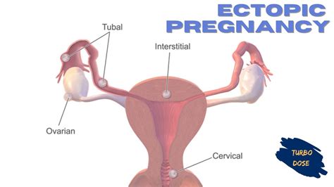 Ectopic Pregnancy Youtube