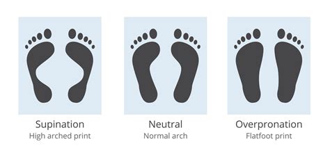 What Is Overpronation Overpronation Flat Feet Pain And How To Fix It
