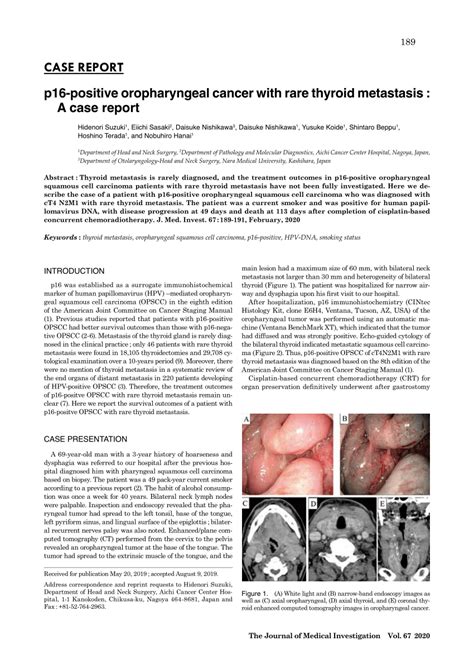 Pdf P16 Positive Oropharyngeal Cancer With Rare Thyroid Metastasis