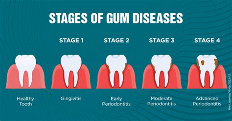 Understanding Periodontitis Causes Symptoms Prevention And Treatment