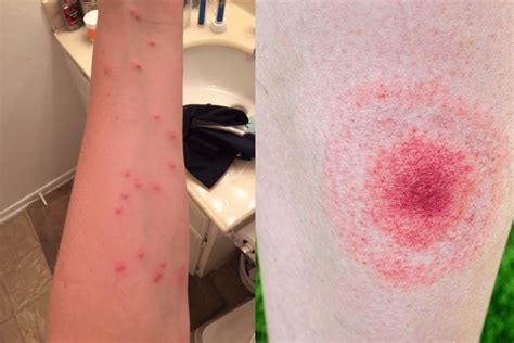 51 Bed Bug Pictures Real Photos Of Bed Bug Bites