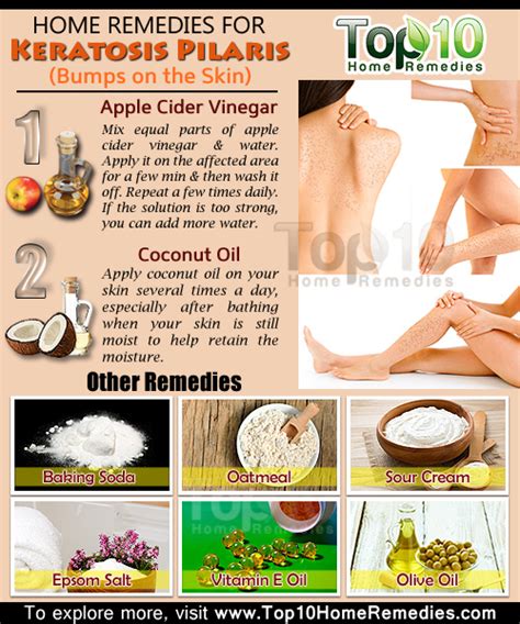 Cure For Keratosis Pilaris Home Remedies Dorothee Padraig South West