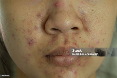 Womans Face With Acnecloseup Acne On Womans Face With Rash Skin Scar