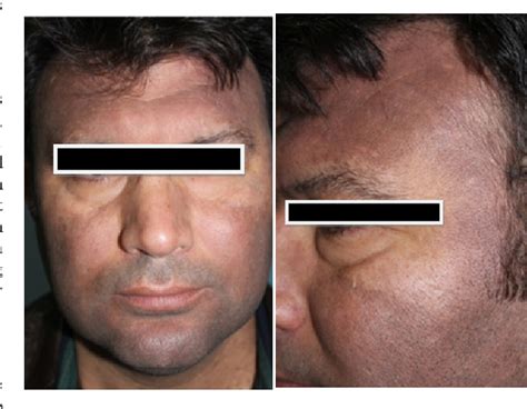 Figure 1 From Is Dermal Melasma A Phototoxic Reaction A Case Report