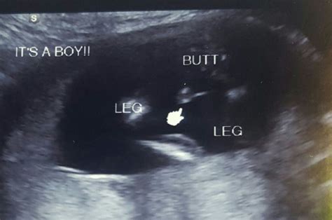 Wrong Gender Reveal Ultrasound At Weeks Babycenter