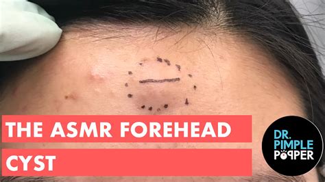 The Asmr Forehead Cyst Cystactular Cysts Dr Pimple Popper