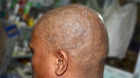 Sores On Scalp Pictures Austra Health
