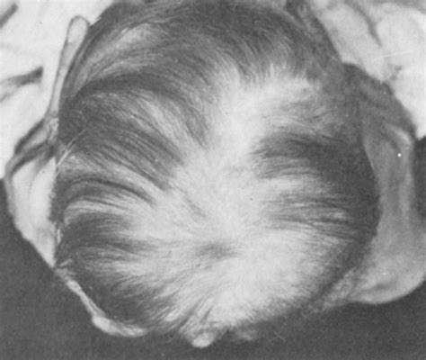 Congenital Defects Of The Scalp In Journal Of Neurosurgery Volume 33
