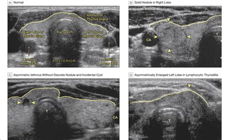 An ultrasound is a type of imaging study that uses ultrasonic sound waves to. A 64-Year-Old Woman With a Thyroid Nodule | Otolaryngology ...