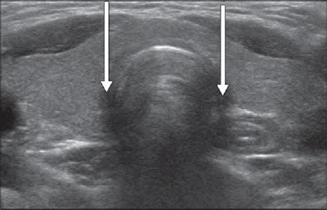 Ultrasound Findings Of Papillary Thyroid Carcinoma Originating In The