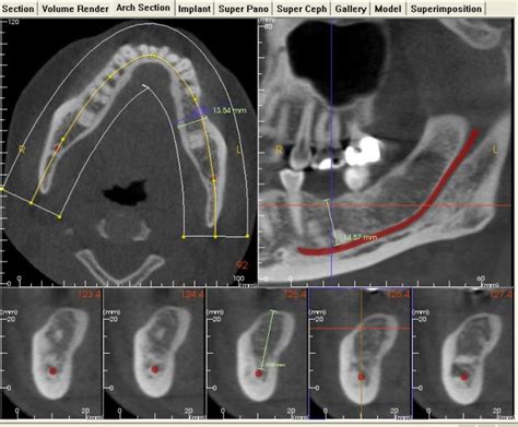 About Your Teeth Cone Bean Computerised Tomography Cbct About Your