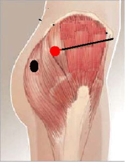 The Red Circular Area Represents The Ventrogluteal Injection Site While The Black One