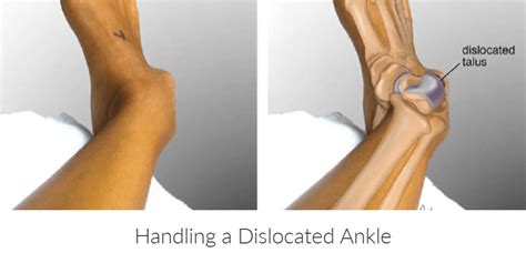 Handling A Dislocated Ankle