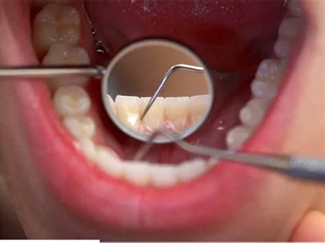 WHO Oral Health Neglect Affecting Nearly Half Of Worlds Population