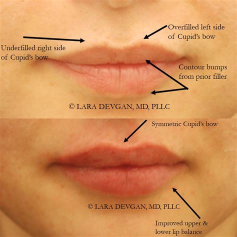 Juvederm Lumps Inside Lips Lipstutorial Org