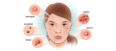 Understanding Acne Types And Prevention Bryan Simmons Chiropractic