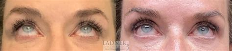 Eyelid Surgery Blepharoplasty Before And After Pictures Case Denver CO Ladner Facial