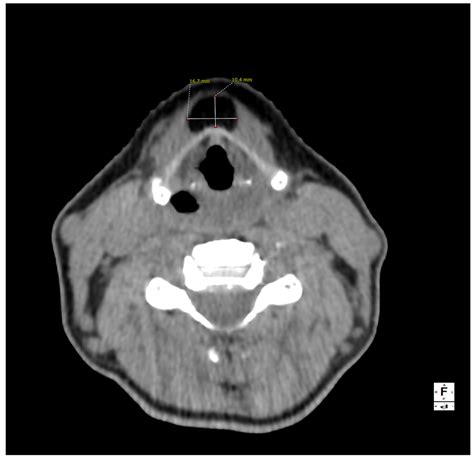 Diagnostics Free Full Text Thyroglossal Duct Lipoma A Case Report
