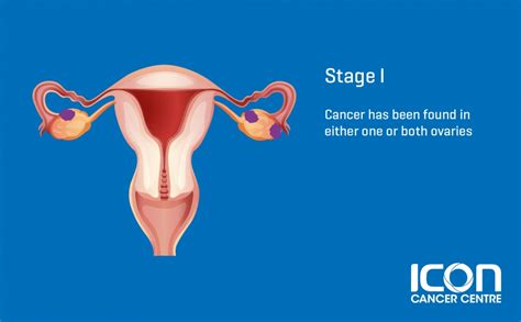What Is Ovarian Cancer Ovarian Cancer Explained Icon Cancer Centre