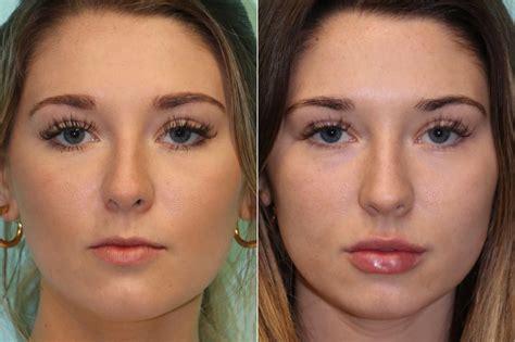 Lip Augmentation Before And After Photos Page 5 Of 6 The Naderi