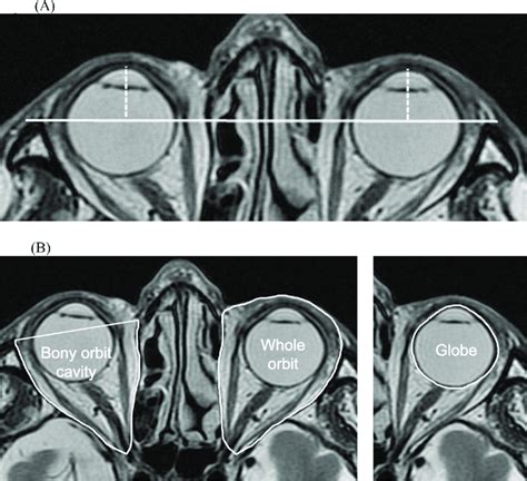 A Measurement Of The Proptosis By Axial Magnetic Resonance Imaging A