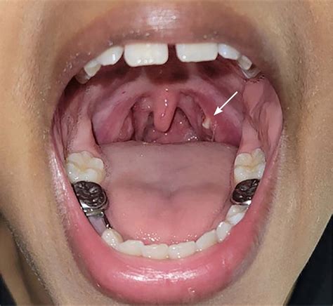 Tonsillitis And Tonsilloliths Diagnosis And Management Aafp