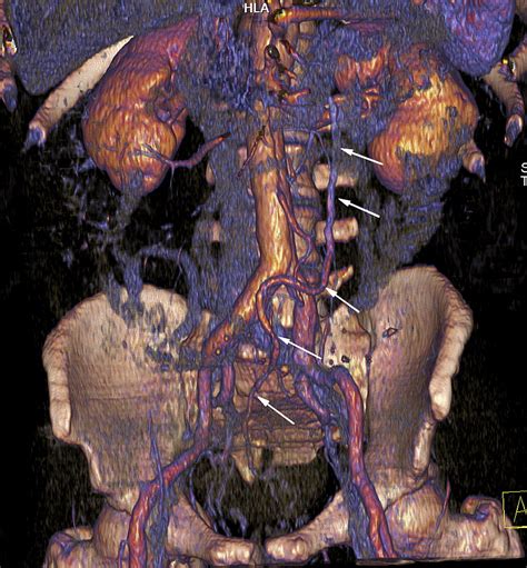 Mdct Of Inferior Mesenteric Vein Normal Anatomy And Pathology