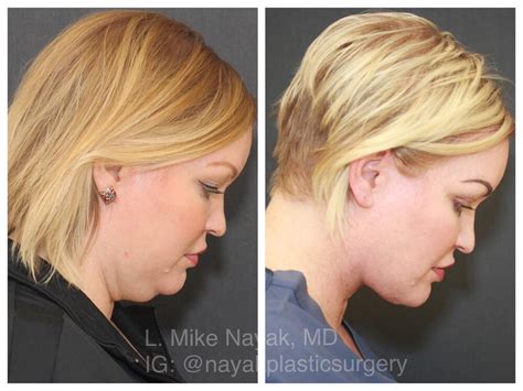 Deep Necklift Before And After Patient 13 Nayak Plastic Surgery