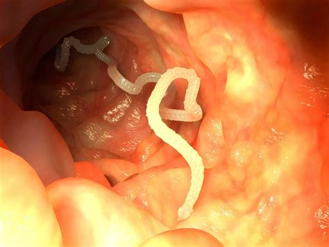 Colombian Man First To Die From Tapeworm Developing Cancer Metro News