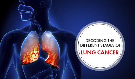 Decoding The Different Stages Of Lung Cancer Cancer Healer Center