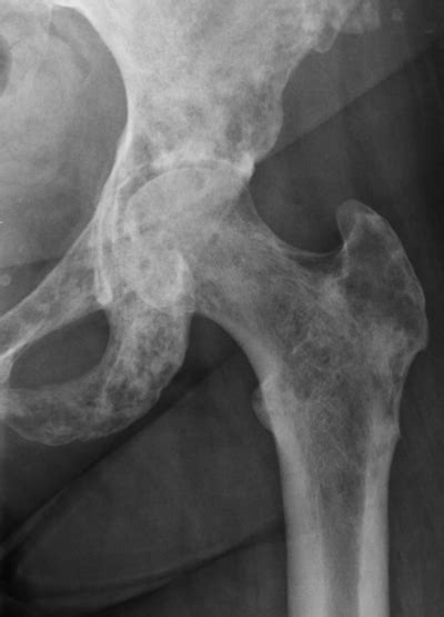Bone Lesions Case 1 Additional Images Orthopedic Teaching Feinberg