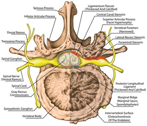 Lumbar Stenosis Treatment Without Surgery Regenexx