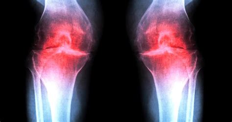 What Are The Causes Symptoms And Treatments For Osteoarthritis