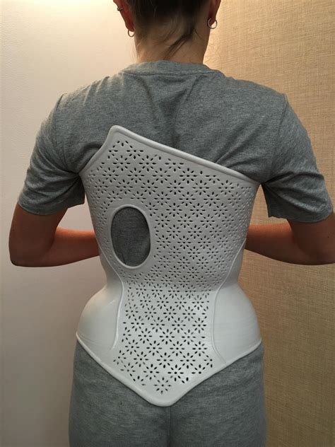 These 3d Printed Braces Give Us A Better Way To Treat Scoliosis