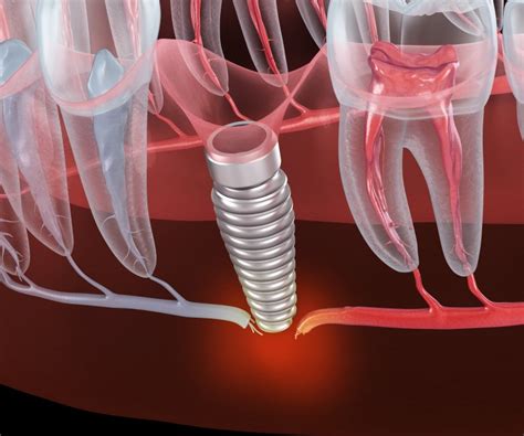 Signs Of A Failed Dental Implant Missing Tooth Grand Dental Channahon
