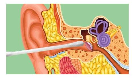 ear seed placement for tinnitus