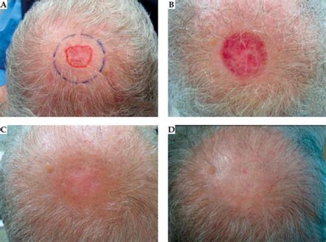 Basal Cell Skin Cancer On Scalp