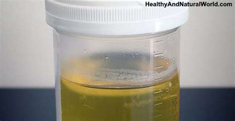 White Stuff Or Particles In Urine What It Means And What To Do