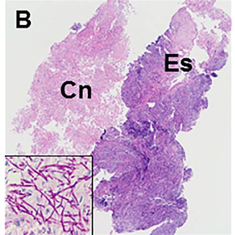 PDF Esophageal Candidiasis As The Initial Manifestation Of Acute Myeloid Leukemia