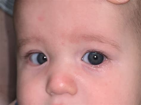 An epicanthic fold or epicanthus is a skin fold of the upper eyelid that covers the inner corner (medial canthus) of the eye. Epicanthal Folds Vs Normal Eye ~ news word
