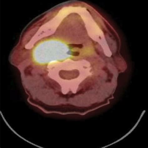 Pet Ct Shows Significant Improvement In Large Right Palatine Tonsil