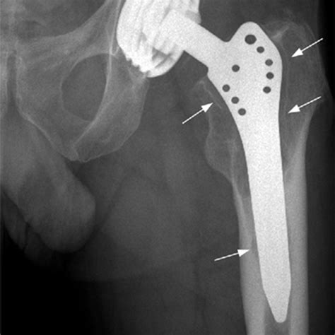 Frontal Radiograph With Gruen Femoral Zones 17 And De Lee Charnley