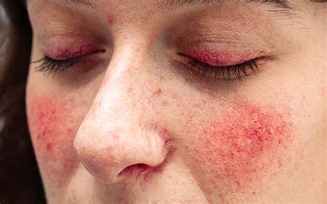 Redness On Face Causes Symptoms Treatments And Prevention Vedix